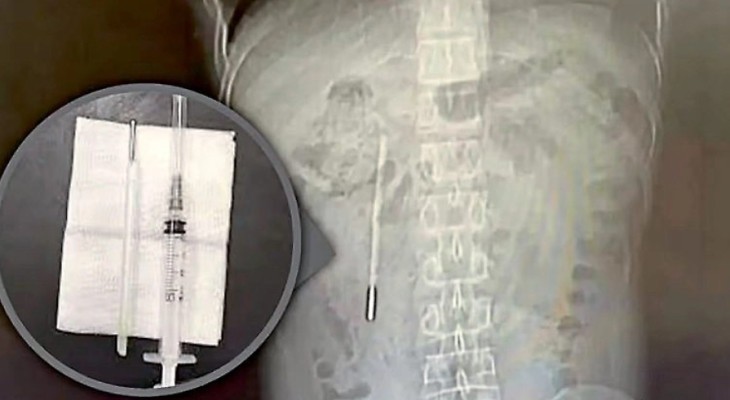 ২০ বছর ধরে তরুণের পেটে থার্মোমিটার